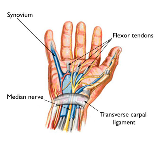 Treating Carpal Tunnel Syndrome with Acupuncture Balance Method ...