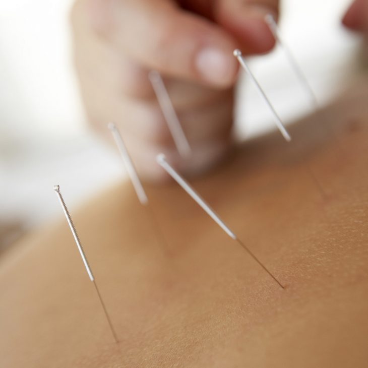 Acupuncture Balance Method Archives | Helianthus Holistic Health Clinic