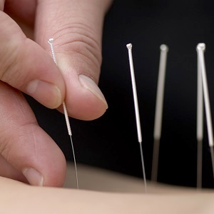 Acupuncture - Treating with Needles at Helianthus Clinic, Tossa de Mar, Spain